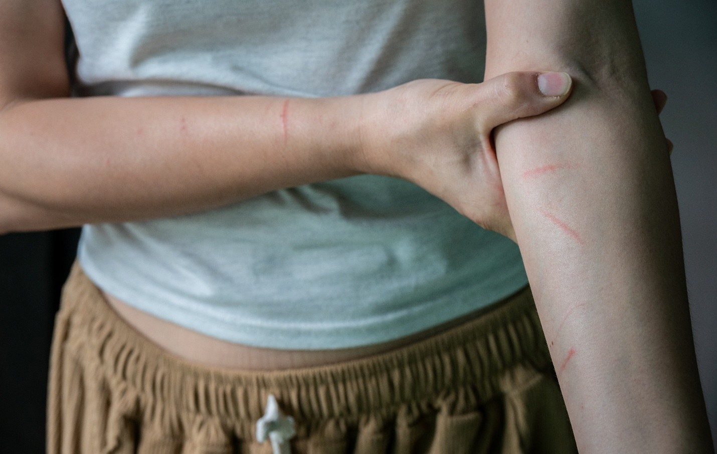 Mengenal Penyebab Utama di Balik Penyakit Cakaran Kucing